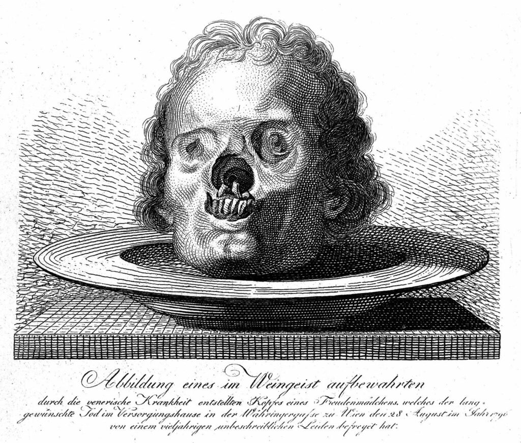 A preserved skull of a woman who had been suffering from syphilis, died in 1796., line engraving. Source: Wellcome Collection