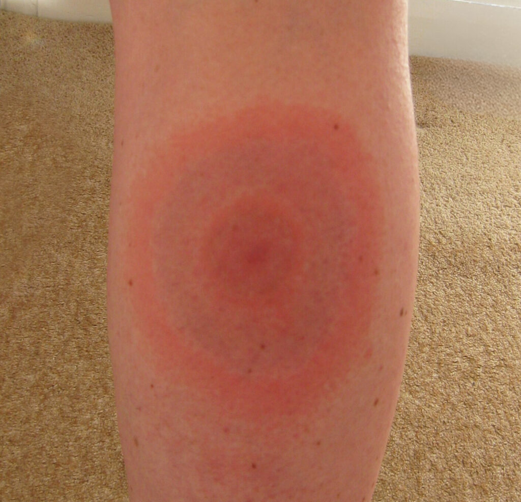 The distinctive bullseye rash that can develop after a tick bite