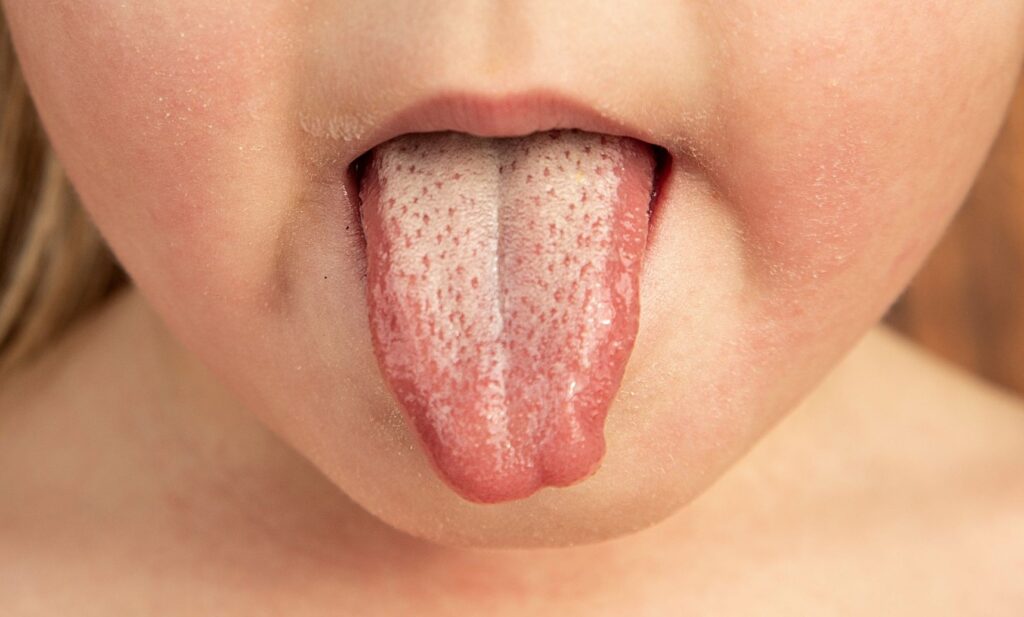A child sticking out their tongue, which shows the white coating that is one of the symptoms of scarlet fever
