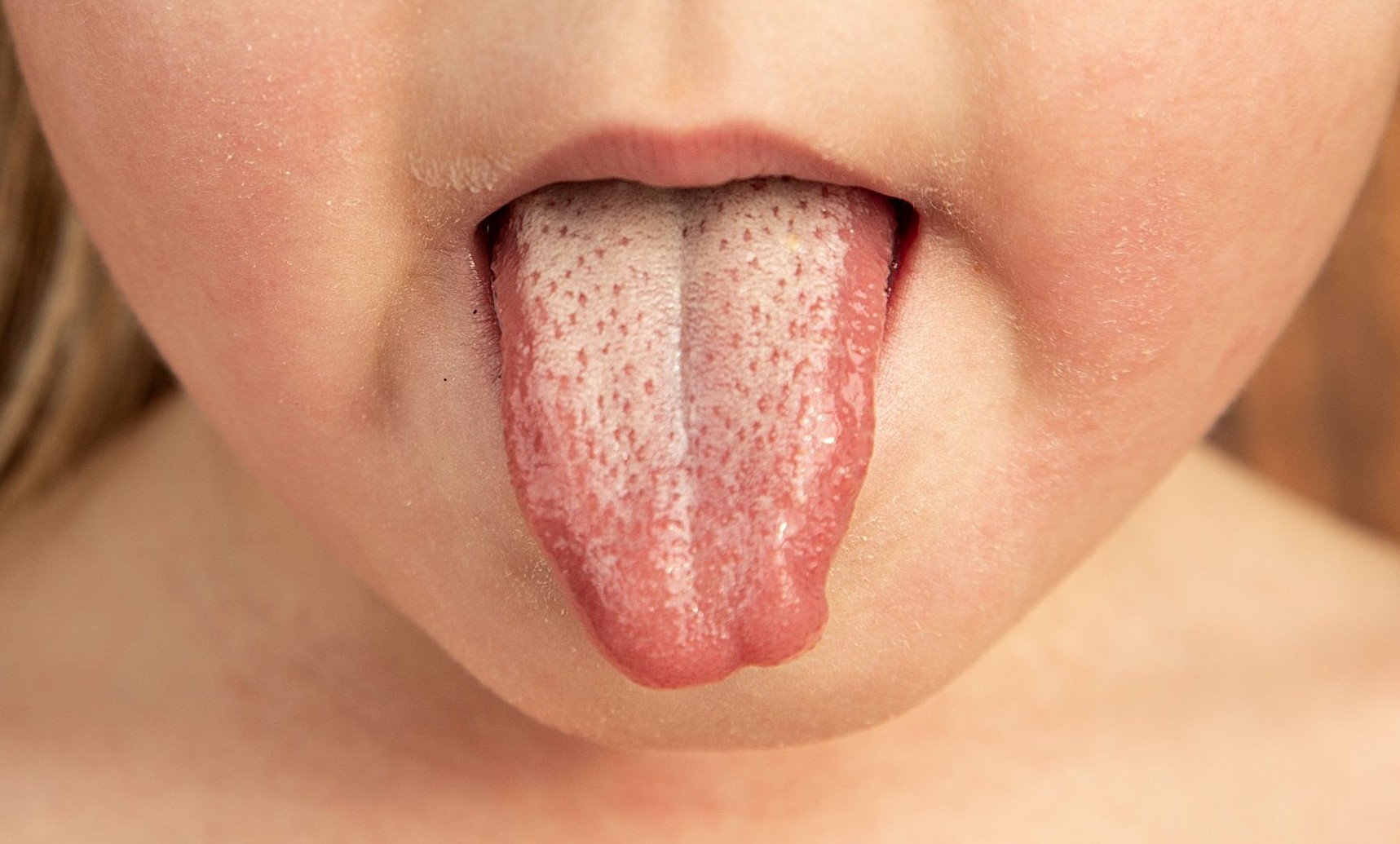 What are the symptoms of scarlet fever and is it contagious?